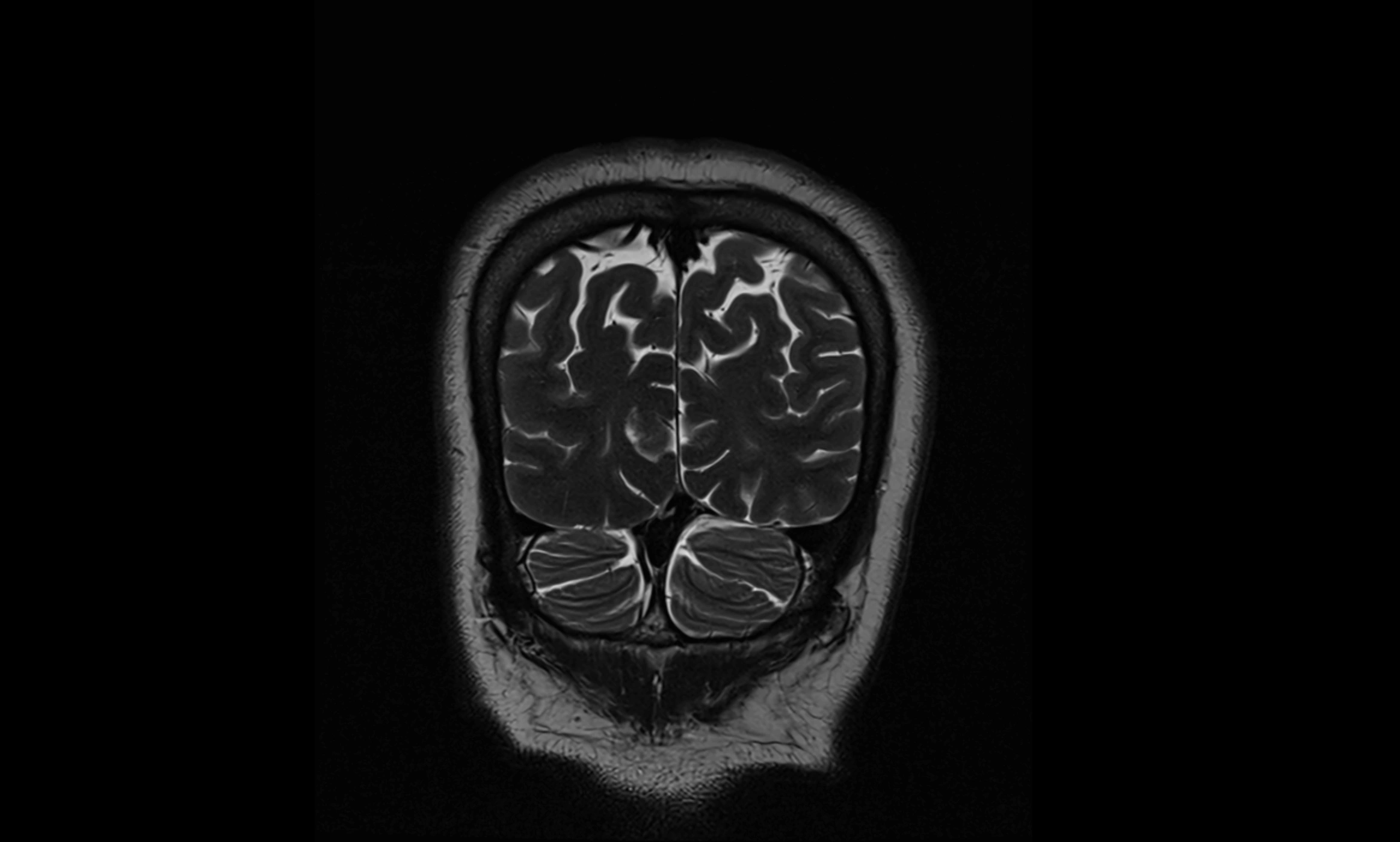 Brain cisterns  and ventricles coronal anatomy 3T MRI image-img-00001-00056.webp